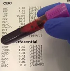 Medical laboratory workshop Episode 7: What does differential white blood cell count say about your health condition?  thumbnail