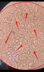 Medical laboratory workshop Episode 4: The human parasitic worm - Strongyloides stercoralis motile Rabditiform larvae caught live  thumbnail