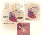 Are you on artificial pacemaker or you know someone that is, this article is for you thumbnail