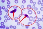 Medical laboratory workshop Episode 10:   Diagnosis and identification of Plasmodium falciparum using stained blood film thumbnail