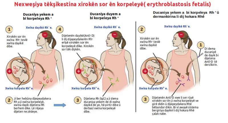 800px-Eritroblastosis_fetalis_ku.png