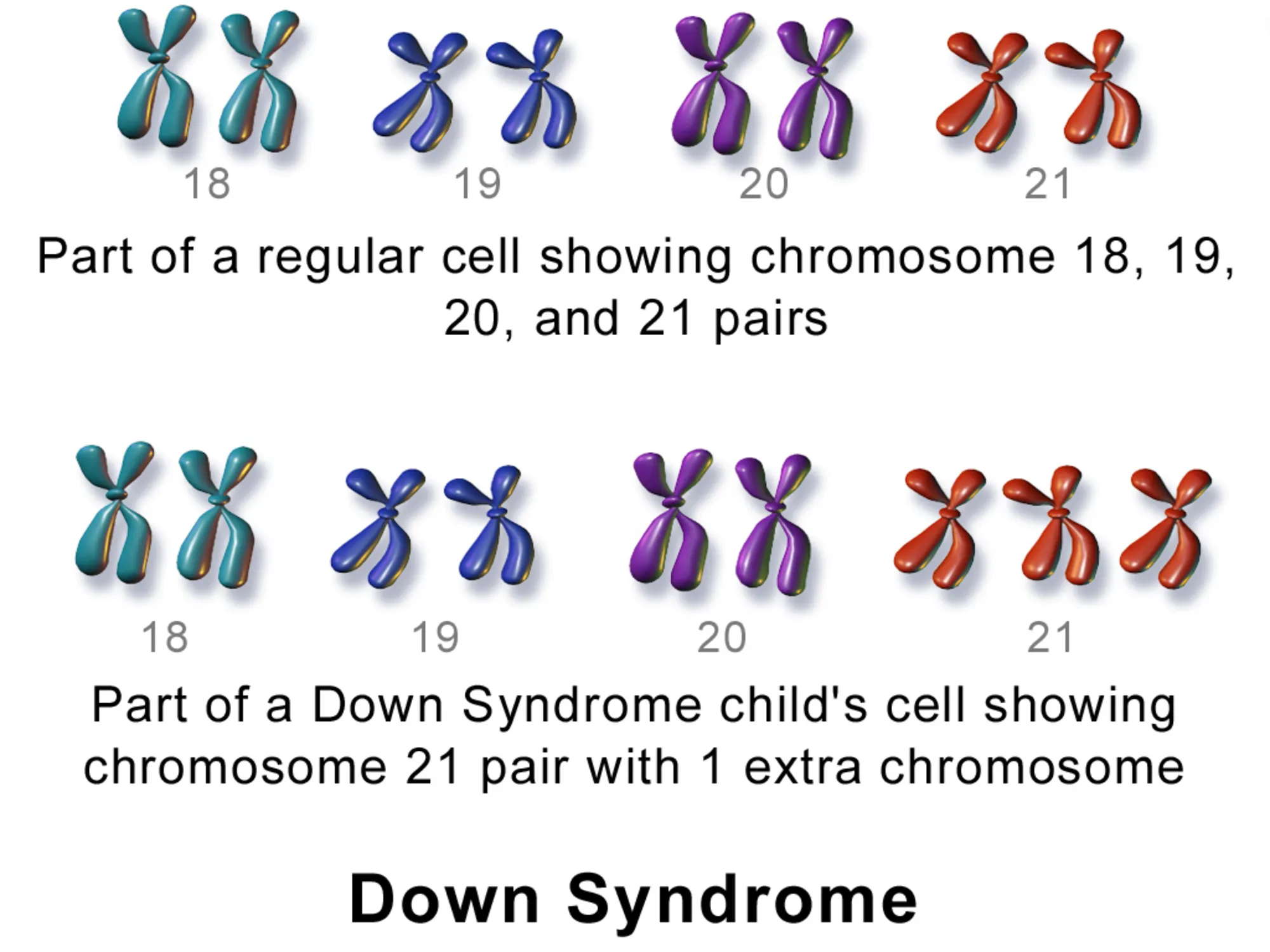 Blausen_0326_DownSyndrome.png