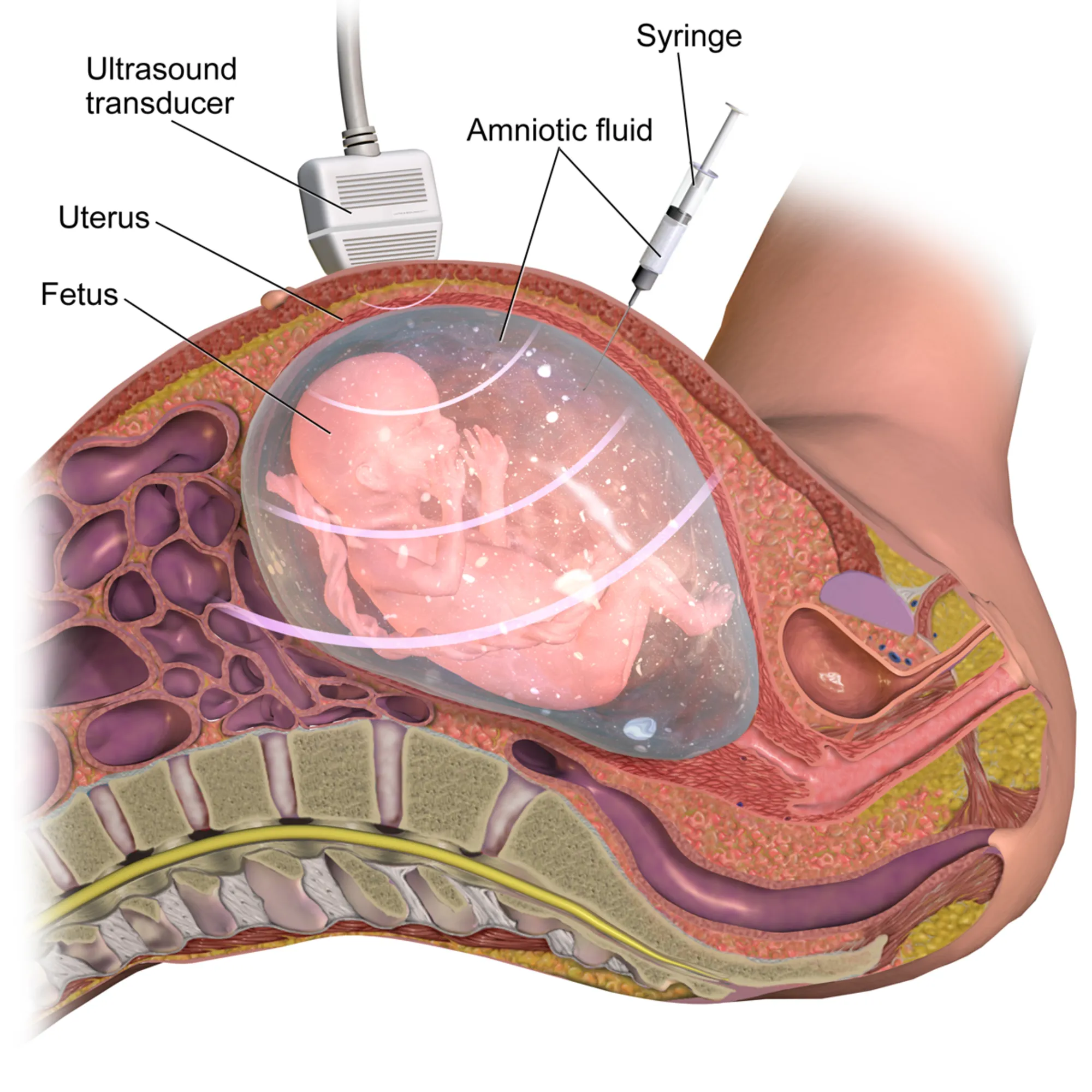 2000px-Amniocentesis.png