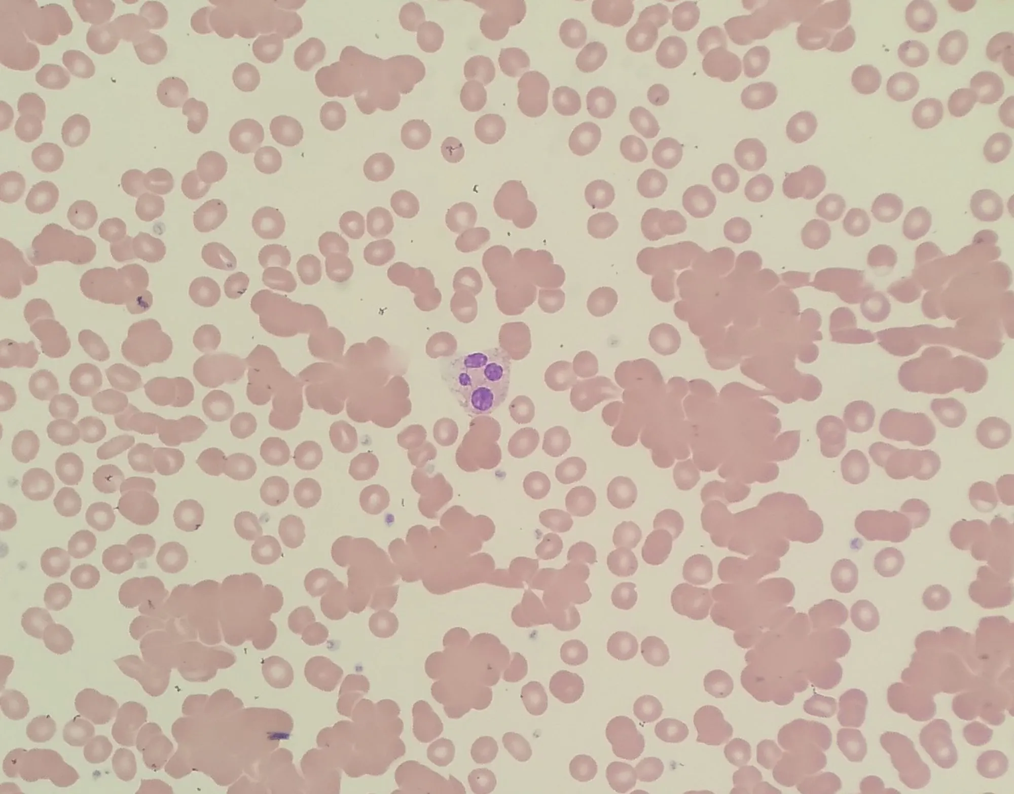 Red_blood_cell_agglutination_due_to_cold_agglutinin.jpg