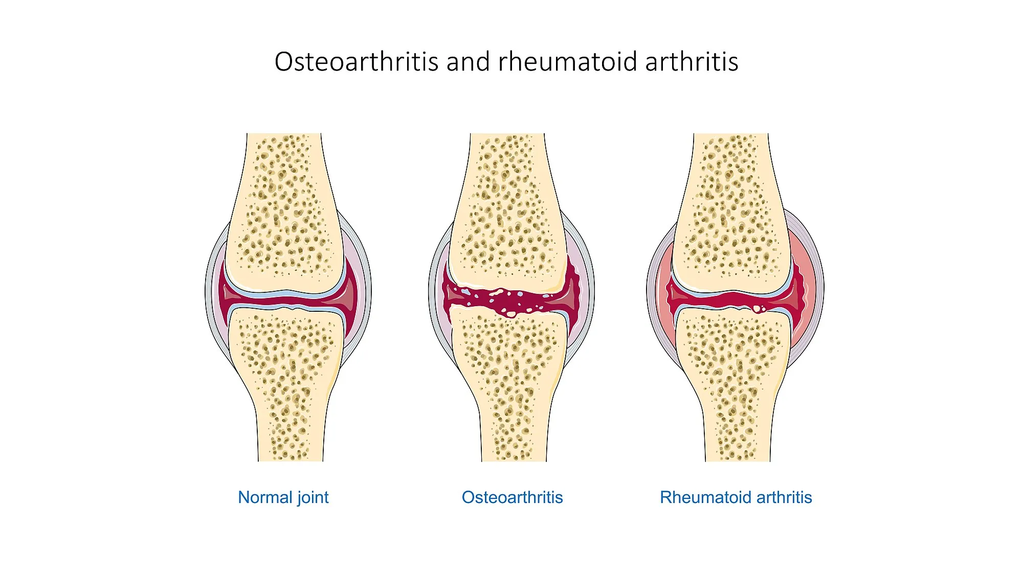 Osteoarthritis_and_rheumatoid_arthritis_-Normal_joint_Osteoarthr--_Smart-Servier.jpg