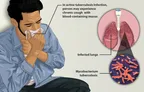 Original research: Level of Correlation of Opportunistic Mycobacterium Spp. Infection with  Western Blot Confirmed Positive HIV-1 Infection in GOPD and S.T.C.  Patients Attending National Hospital Abuja F.C.T. Nigeria thumbnail