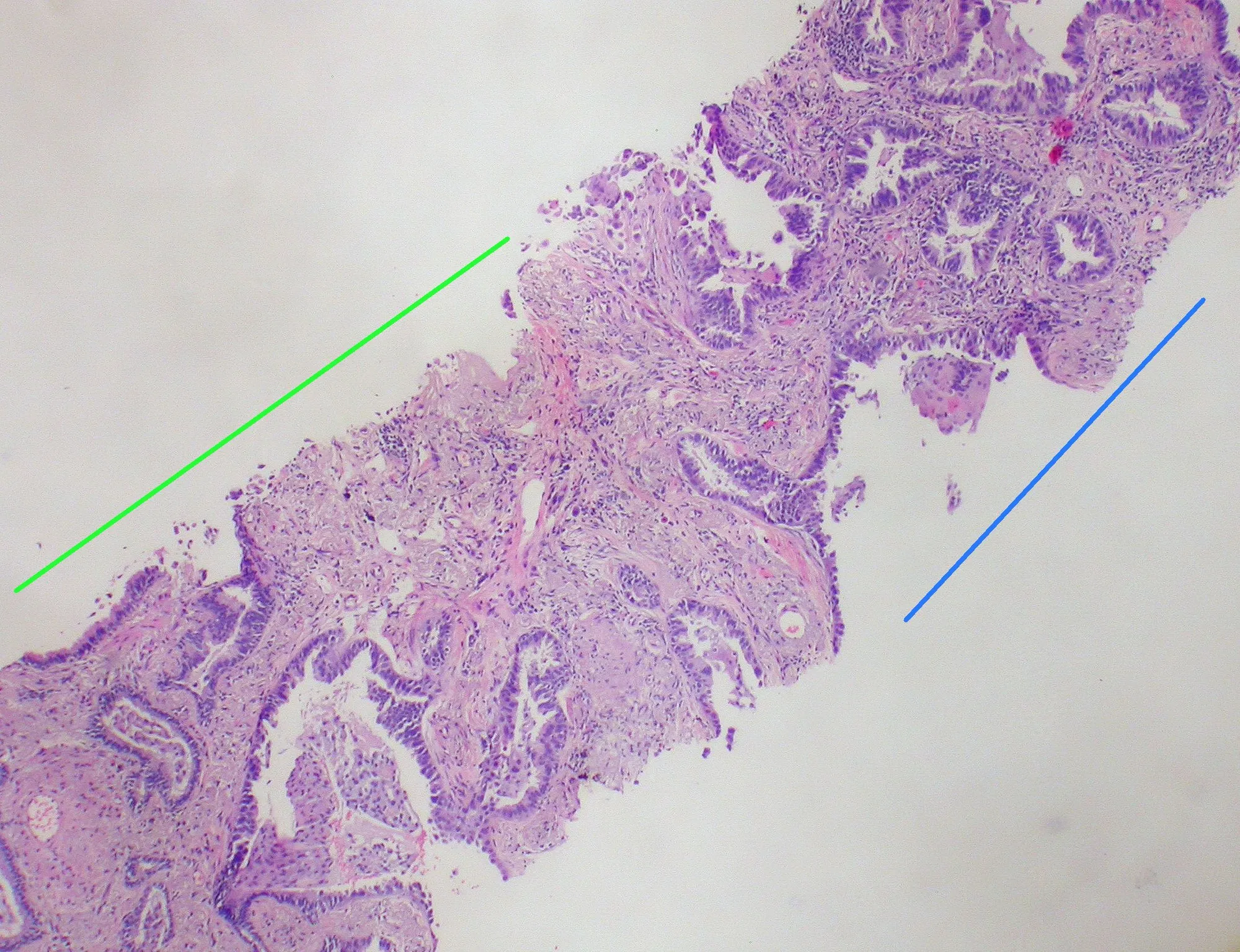 Carcinoma_in_situ_arising_in_bronchiolar_metaplasia_co-existing_with_invasive_adenocarcinoma_Case_274_(9315336088).jpg