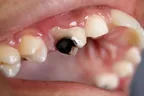 NORMAL MICROBIAL FLORA: their role in tooth decay (dental caries),  mouth odour, body odour and pimples formation thumbnail